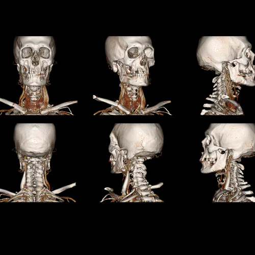 CT Orbit Contrast at Ayucare Diagnostic Center