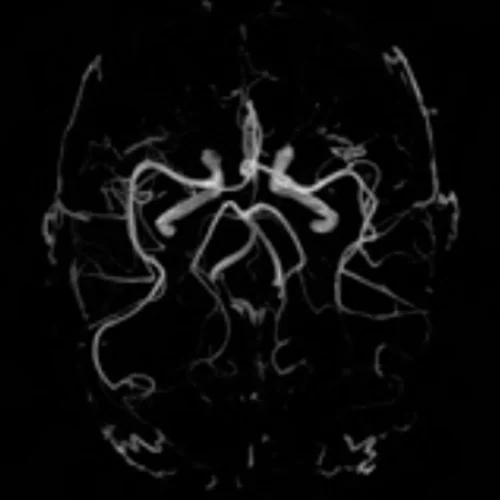 CT Scan