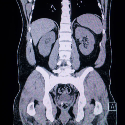 Abdomen MRI at Ayucare Diagnostic Center