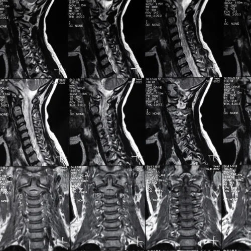 Chest MRI at Ayucare Diagnostic Center